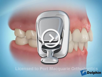 Lingual braces