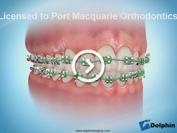 Metal braces colour