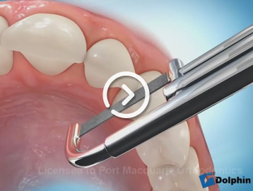 Interproximal reduction (IPR)