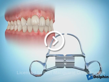 Hyrax rapid palatal expansion braces after