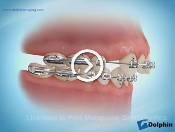 Canine retraction screw