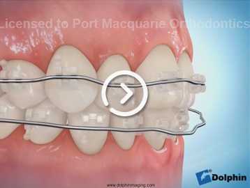 Clear braces