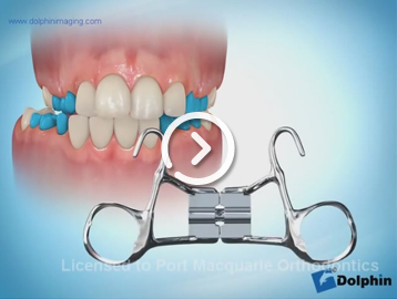 RPE mixed dentition