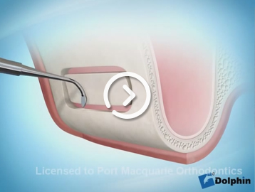 Sinus lift procedure