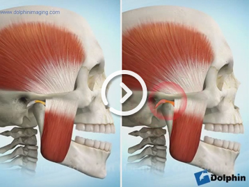 Anterior disc displacement
