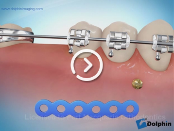 Protraction chain