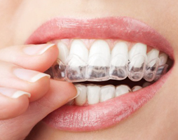 Invisalign