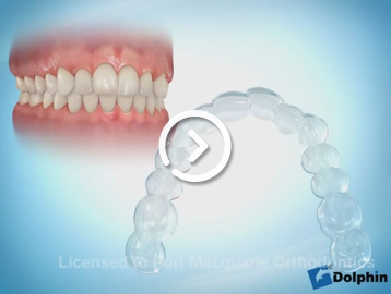 Invisalign