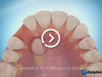 Impacted teeth