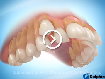 Extractions
