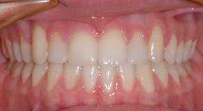 Orthodontic treatment after