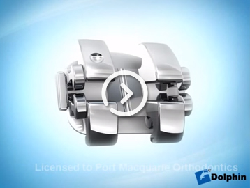 Smartclip braces