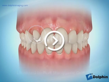 Build up of a tooth