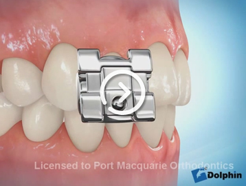 Self-ligating braces