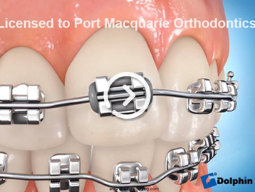 Metal braces grey