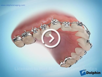 Retainer clear