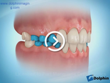 Thumb habit appliance