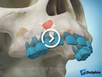 Eruption of impacted teeth