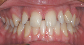 Orthodontic treatment before