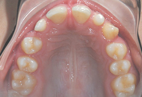 Orthodontic treatment before