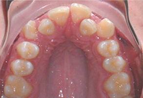 Orthodontic treatment before