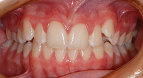 Orthodontic treatment after