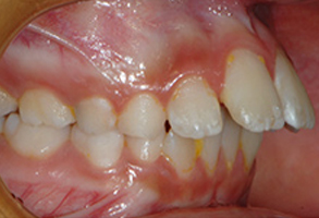 Orthodontic treatment before