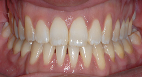 Orthodontic treatment after