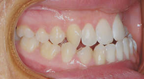 Orthodontic treatment before